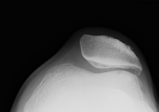 Patella Tilt Moderate OA